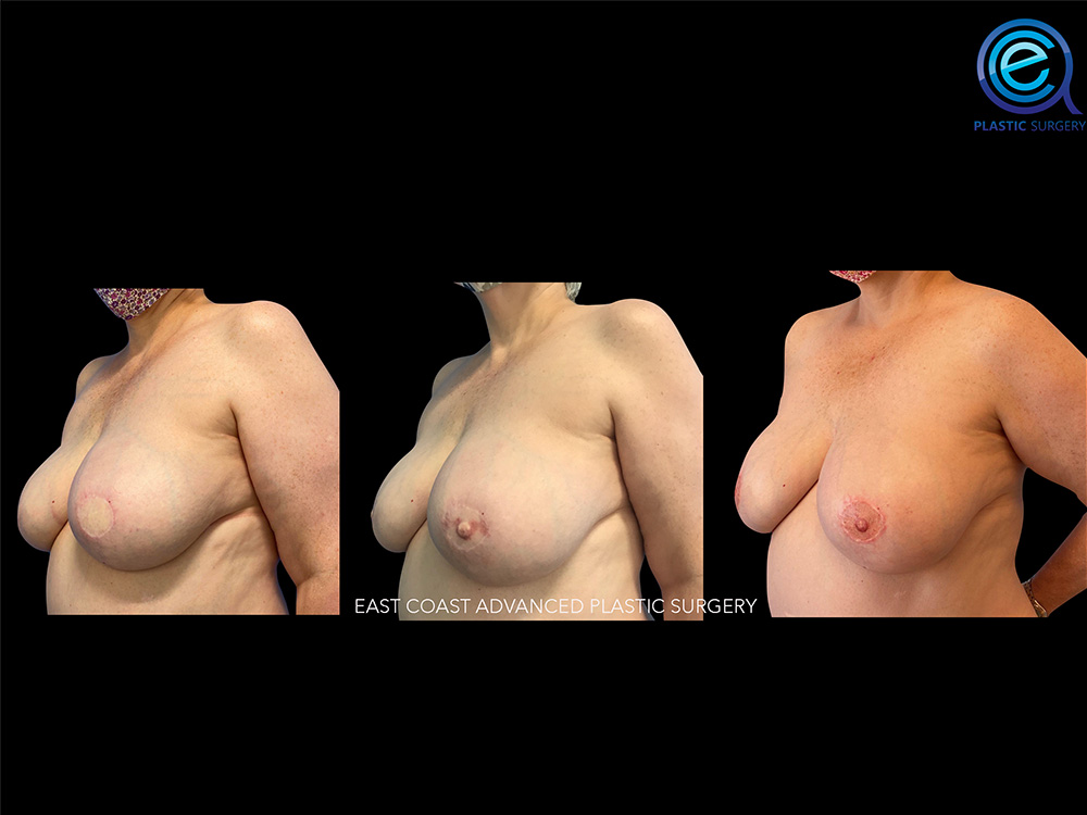 Real patient Breast Reconstruction by ECA Plastic Surgery, New Jersey