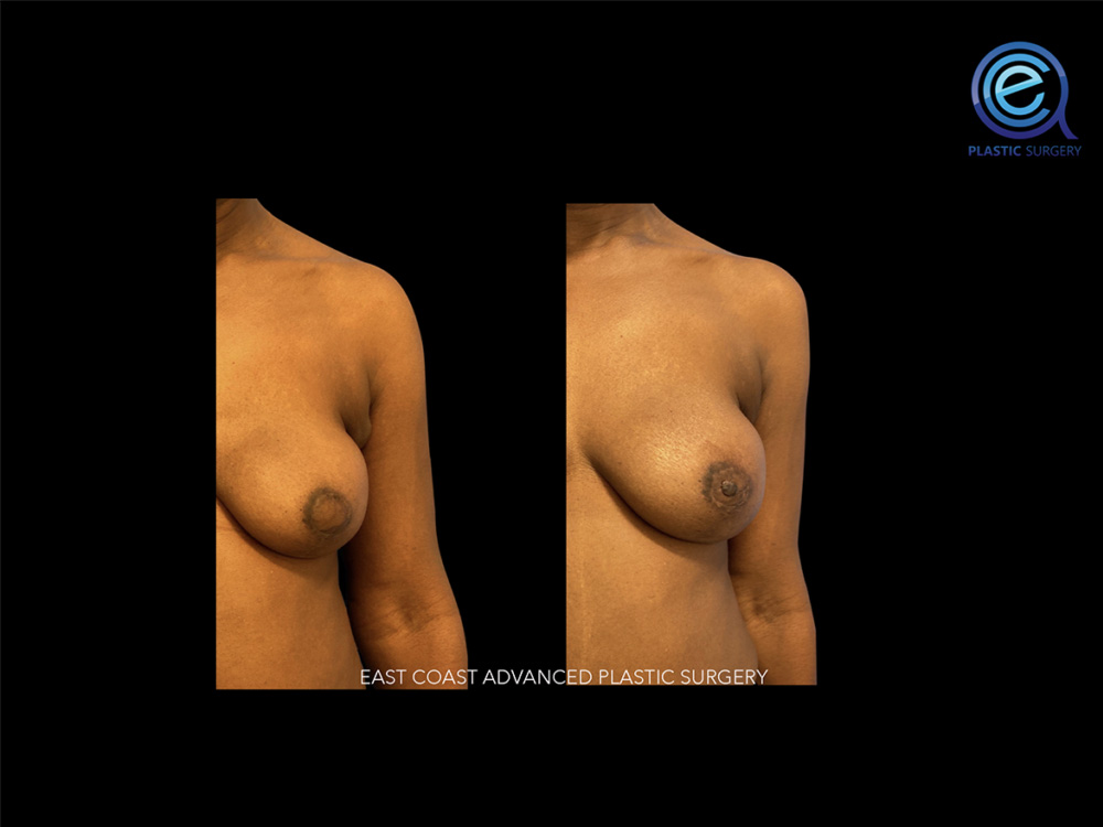 Real patient Breast Reconstruction by ECA Plastic Surgery, New Jersey