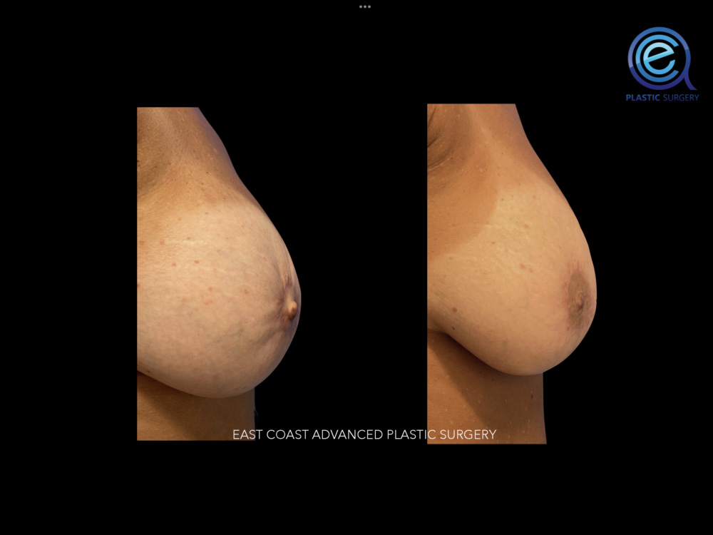 Real patient Breast Reconstruction by ECA Plastic Surgery, New Jersey