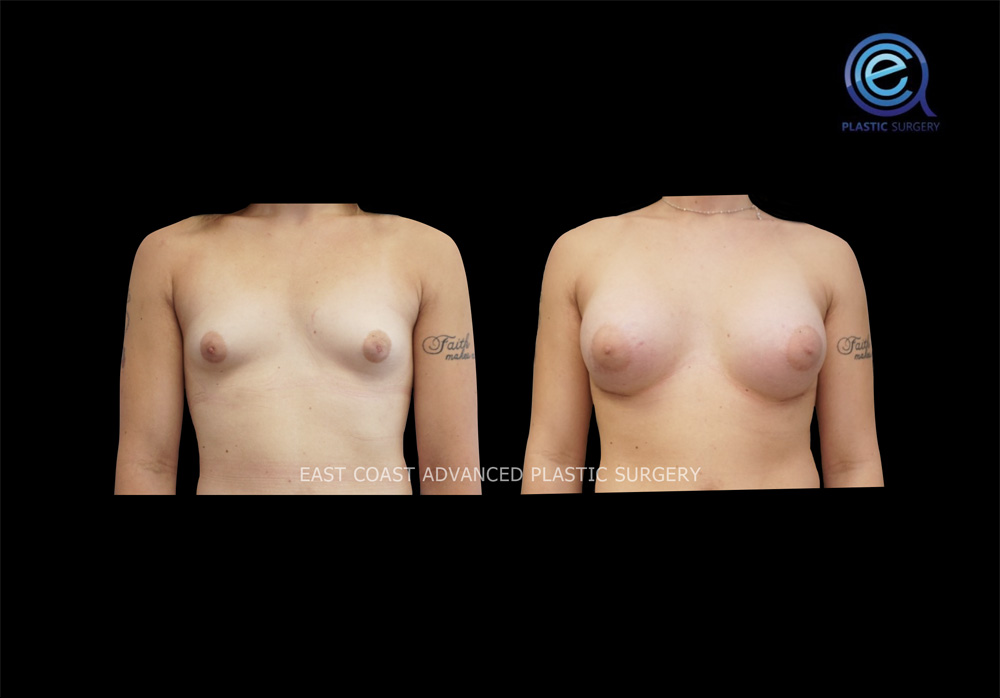 Real patient Chest Feminization by ECA Plastic Surgery, New Jersey