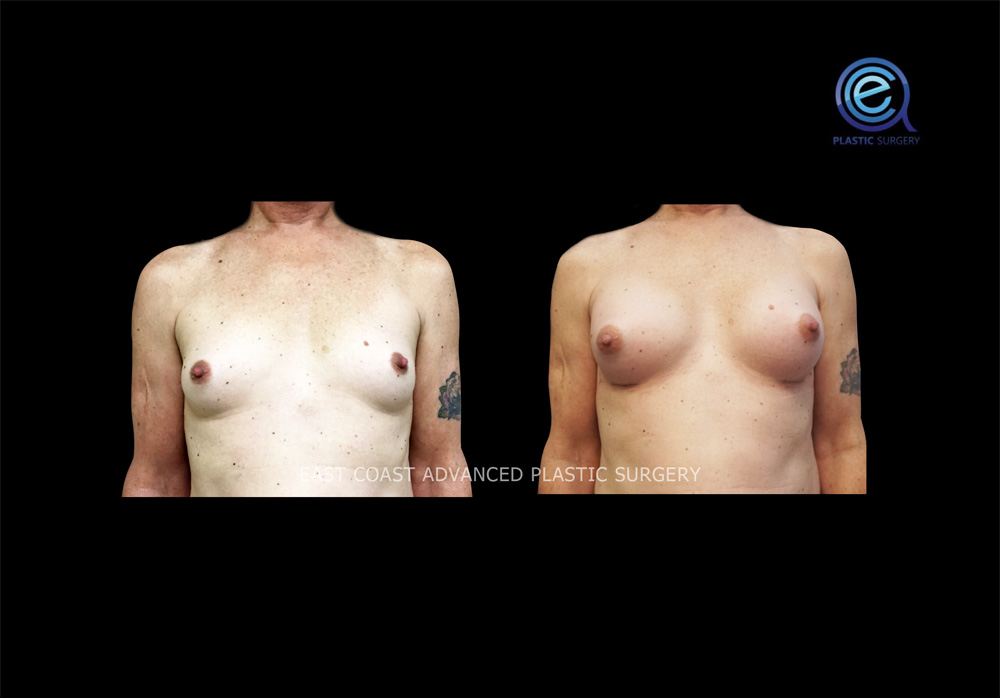Real patient Chest Feminization by ECA Plastic Surgery, New Jersey