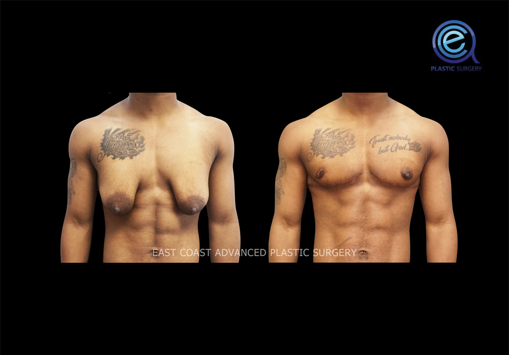 Real patient Chest Masculinization by ECA Plastic Surgery, New Jersey