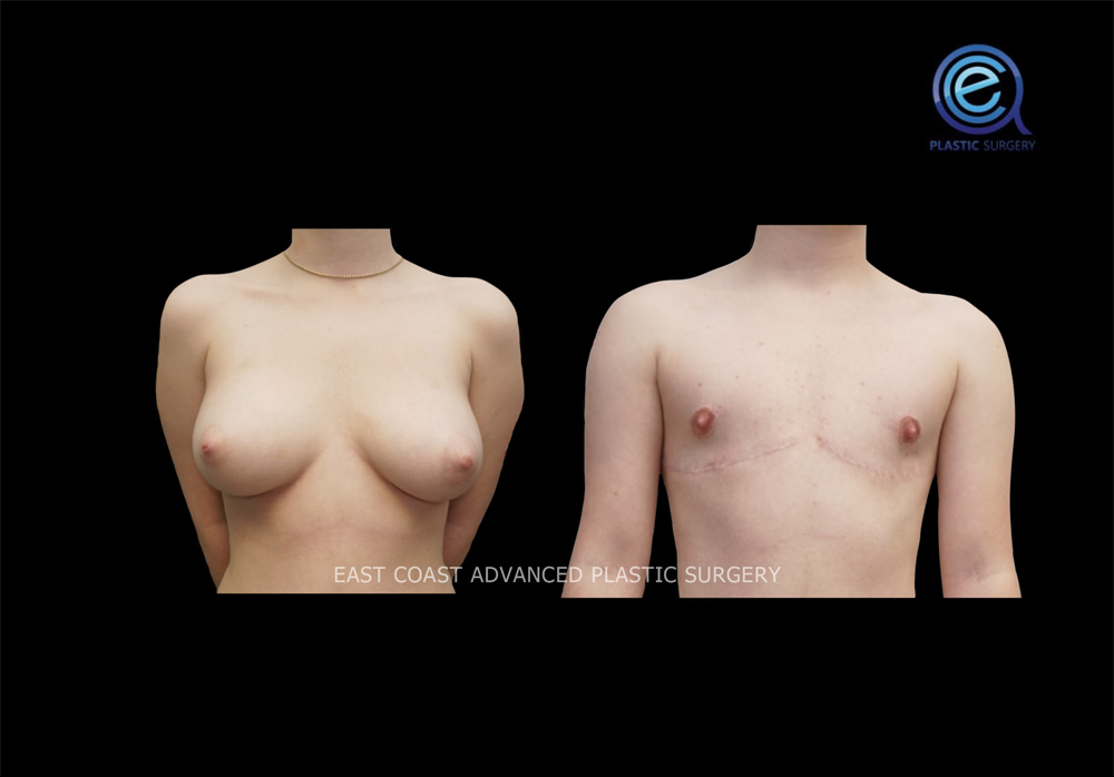 Real patient Chest Masculinization by ECA Plastic Surgery, New Jersey