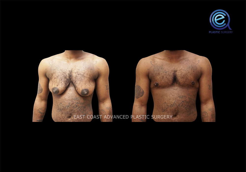 Real patient Chest Masculinization by ECA Plastic Surgery, New Jersey