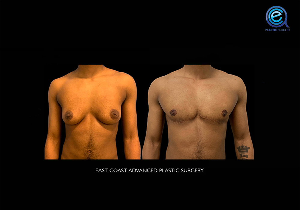 Real patient Chest Masculinization by ECA Plastic Surgery, New Jersey