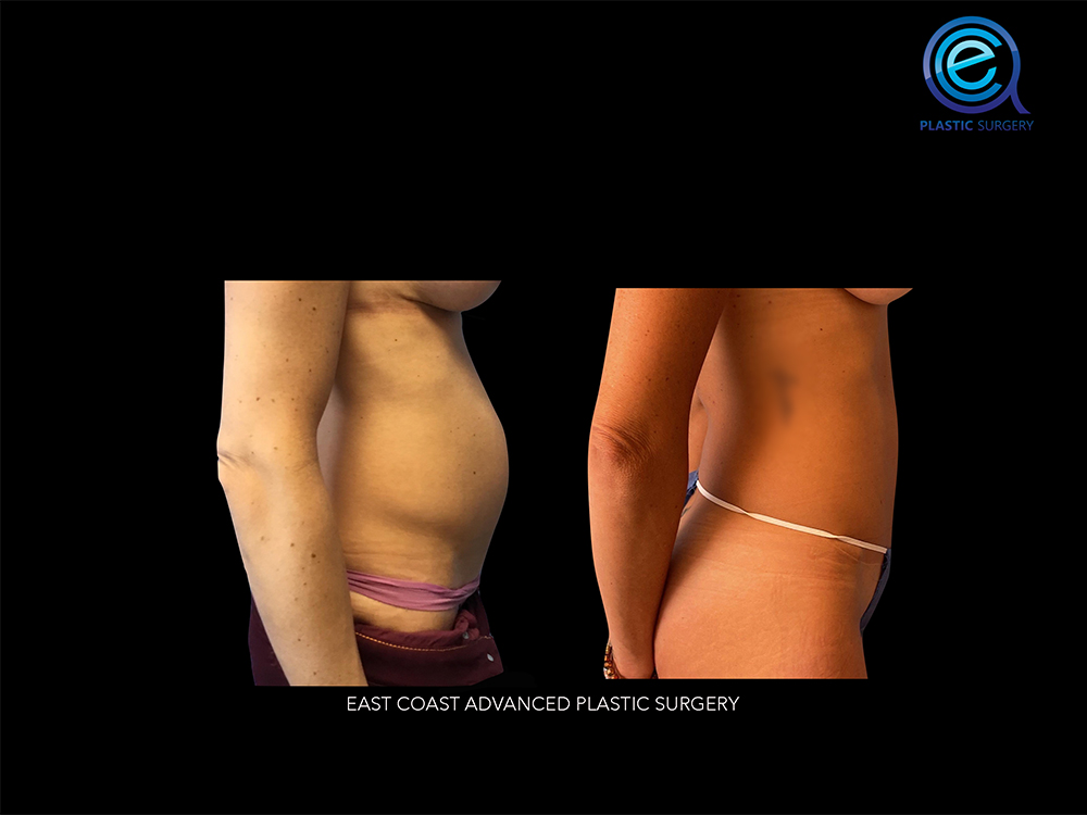 Real patient Abdominoplasty Tummy Tuck by ECA Plastic Surgery, New Jersey
