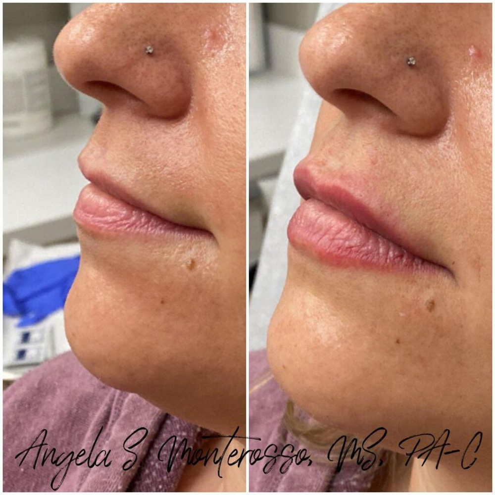 Real patient Lip Augmentation by ECA Plastic Surgery, New Jersey