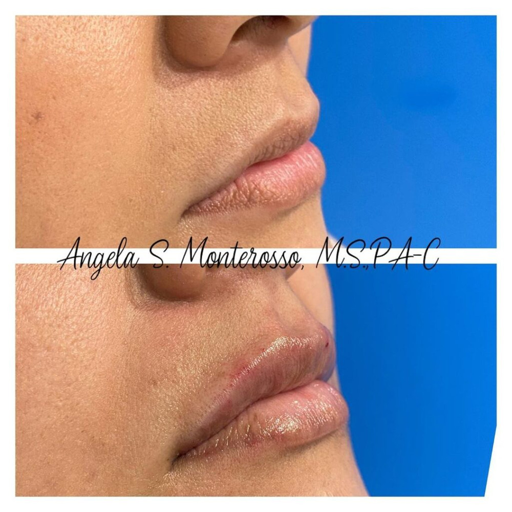 Real patient Lip Augmentation by ECA Plastic Surgery, New Jersey