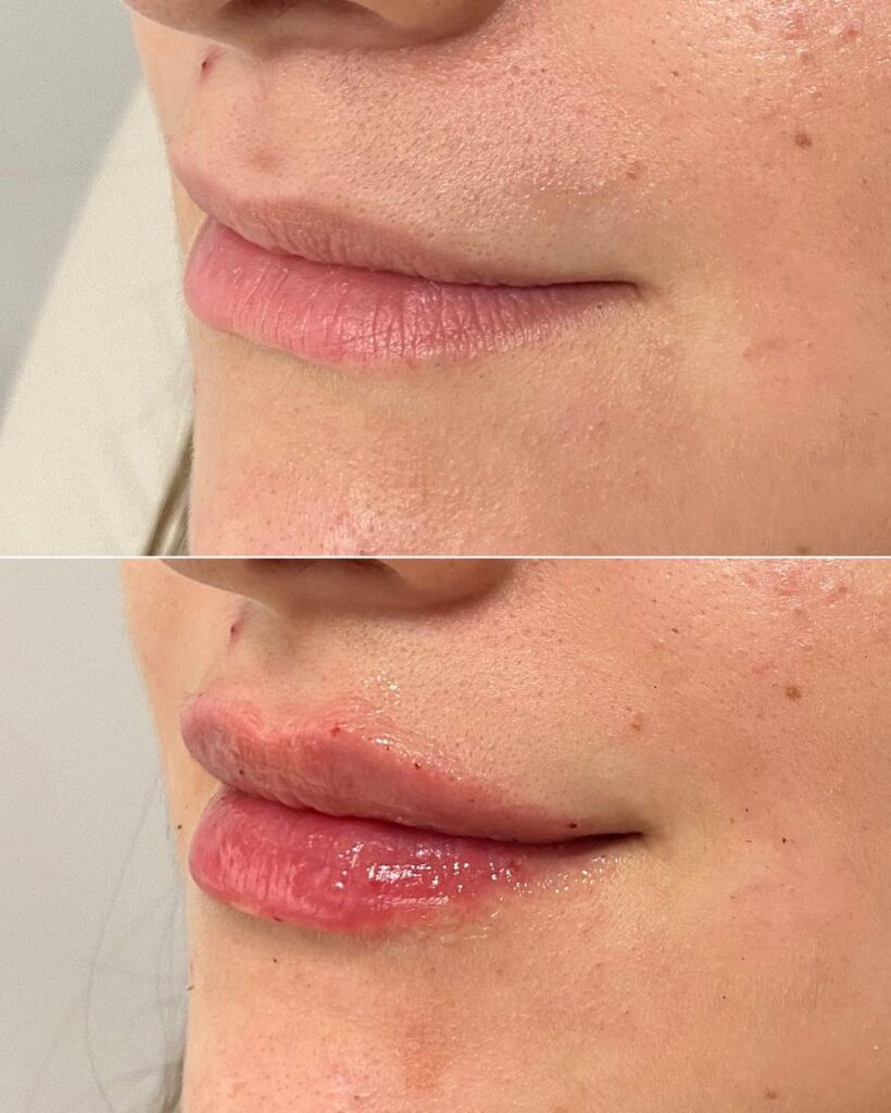 Real patient Lip Augmentation by ECA Plastic Surgery, New Jersey