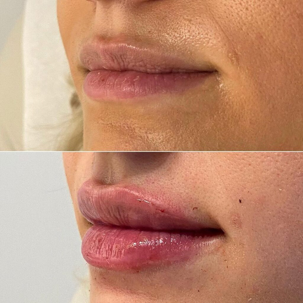 Real patient Lip Augmentation by ECA Plastic Surgery, New Jersey
