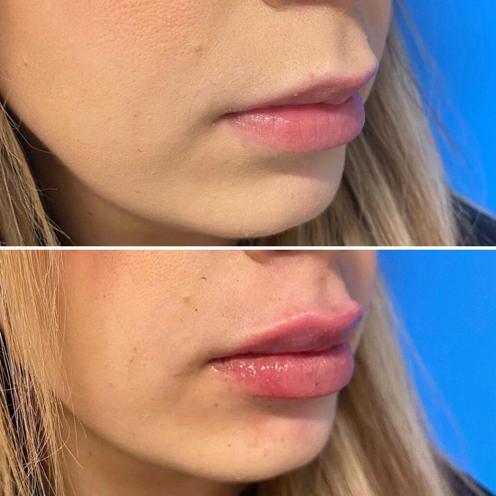 Real patient Lip Augmentation by ECA Plastic Surgery, New Jersey