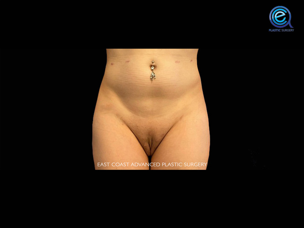 Real patient Vaginoplasty by ECA Plastic Surgery, New Jersey