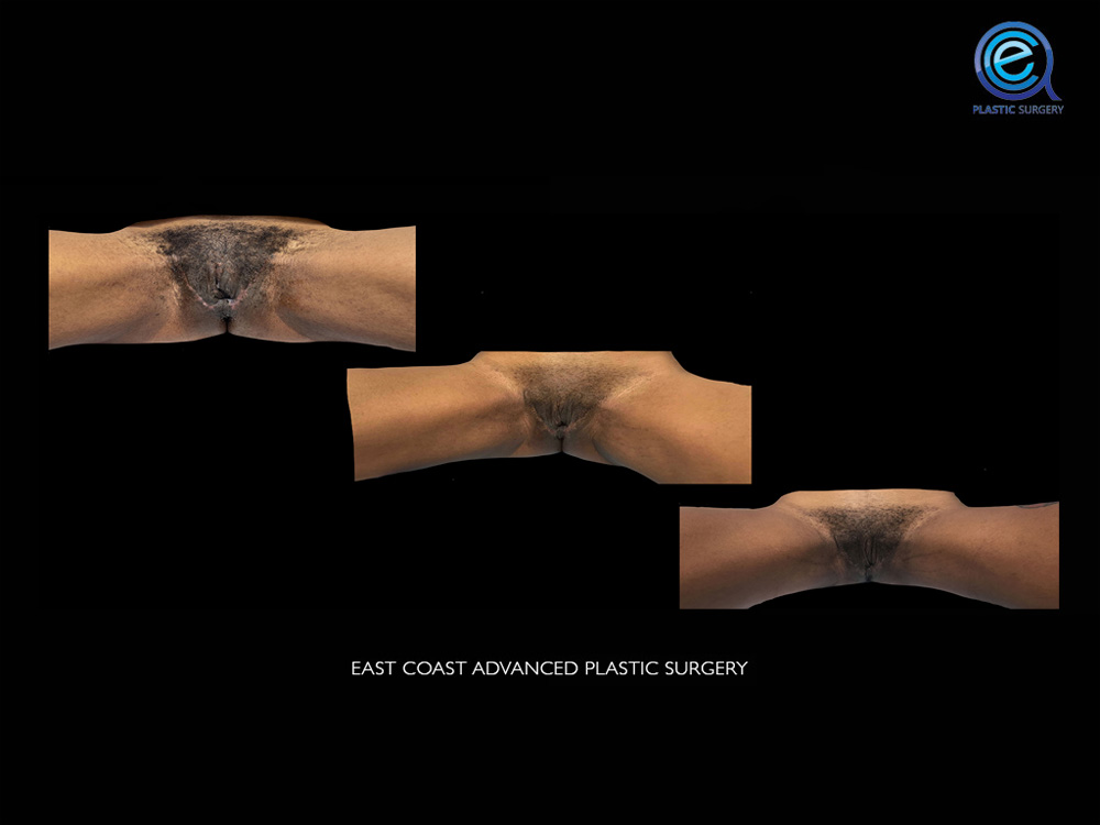 Real patient Vaginoplasty by ECA Plastic Surgery, New Jersey