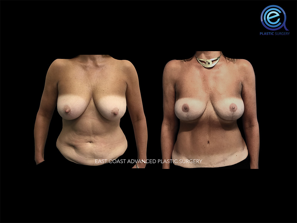 Real patient Breast Reconstruction by ECA Plastic Surgery, New Jersey