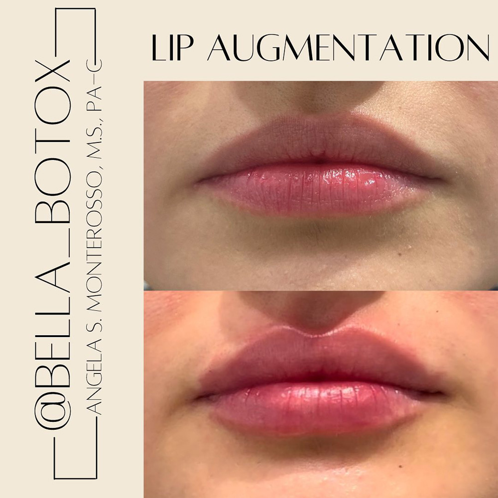 Real patient Lip Augmentation by ECA Plastic Surgery, New Jersey