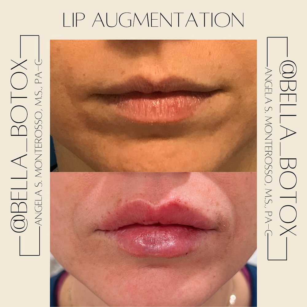 Real patient Lip Augmentation by ECA Plastic Surgery, New Jersey