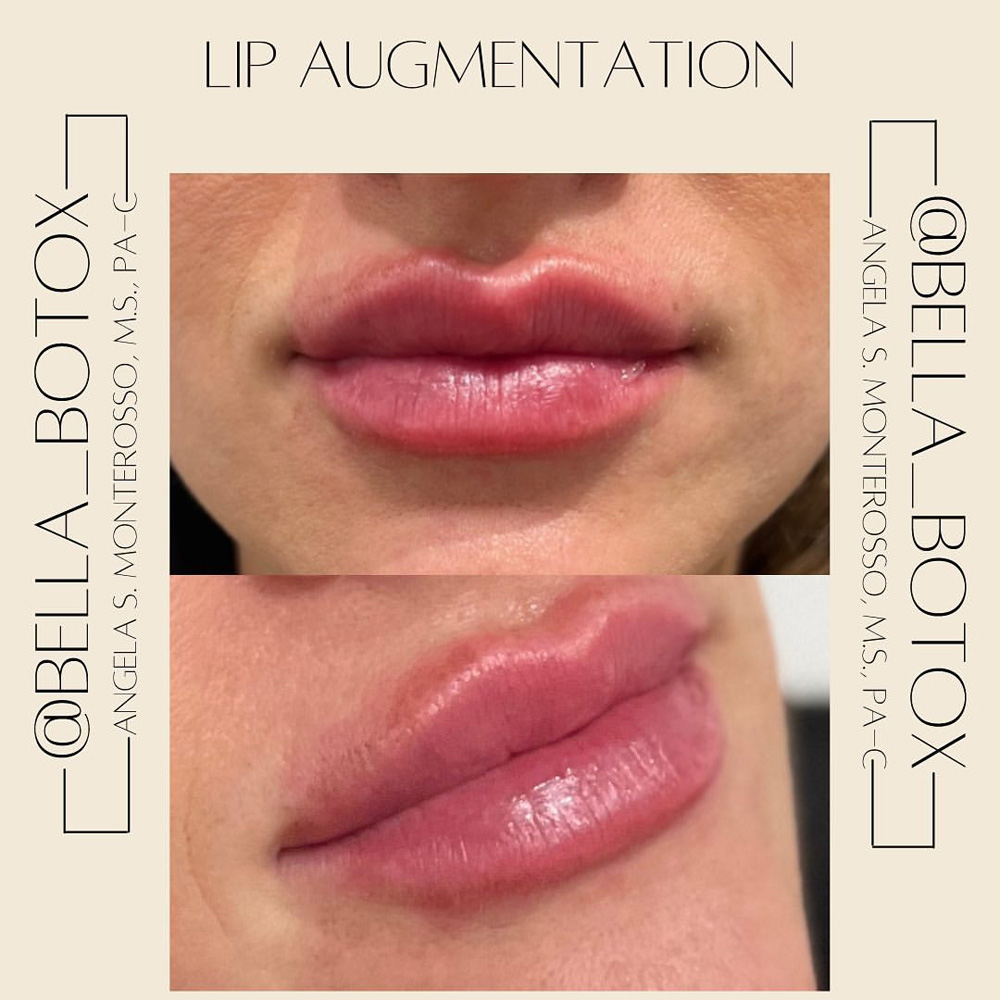 Real patient Lip Augmentation by ECA Plastic Surgery, New Jersey