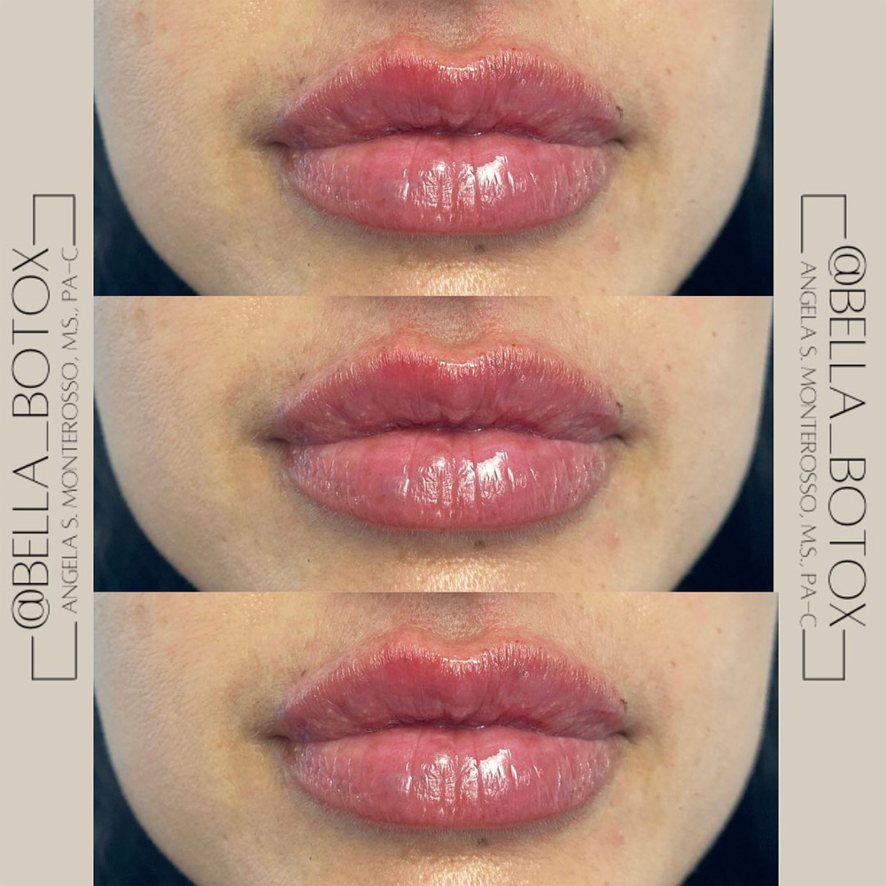 Real patient Lip Augmentation by ECA Plastic Surgery, New Jersey