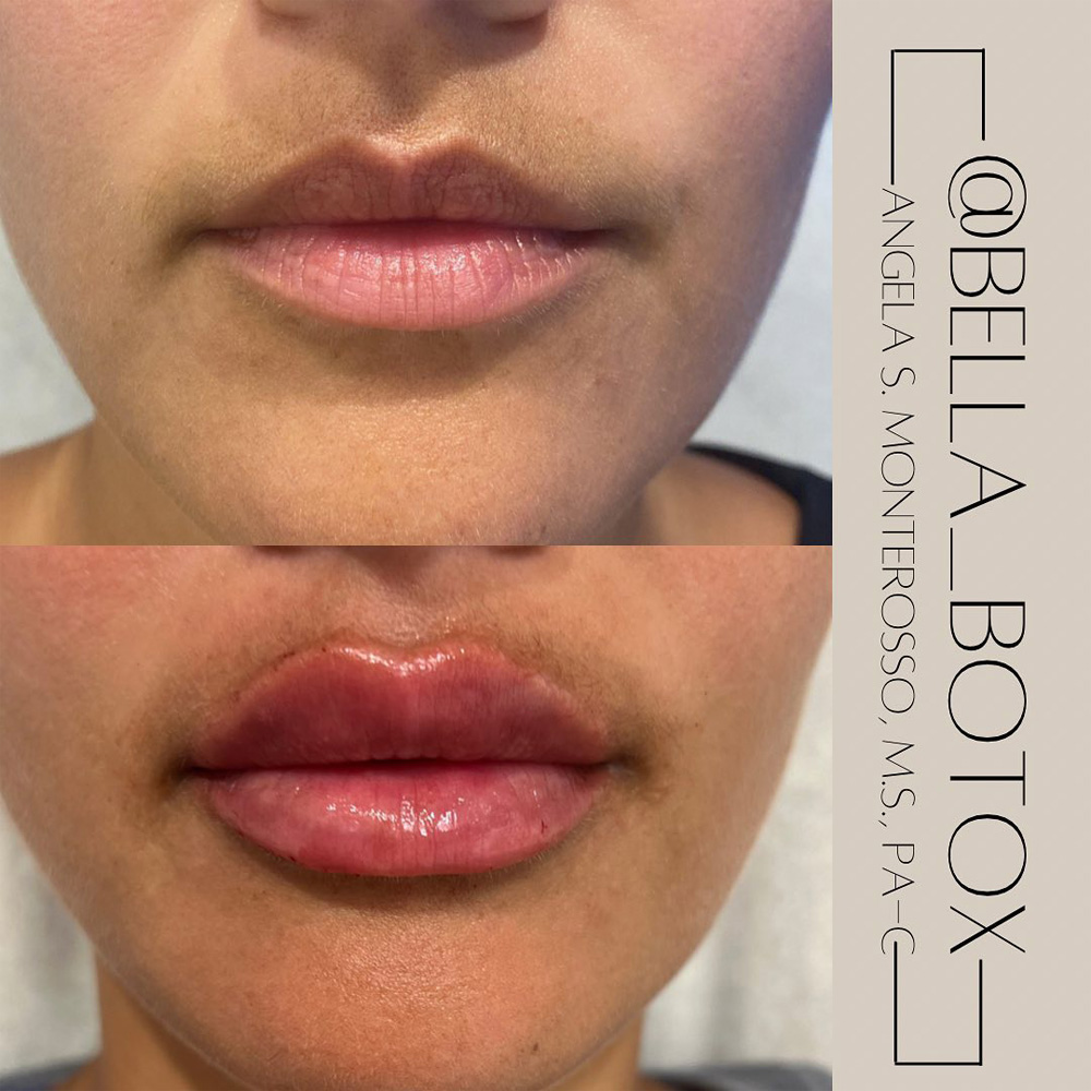 Real patient Lip Augmentation by ECA Plastic Surgery, New Jersey