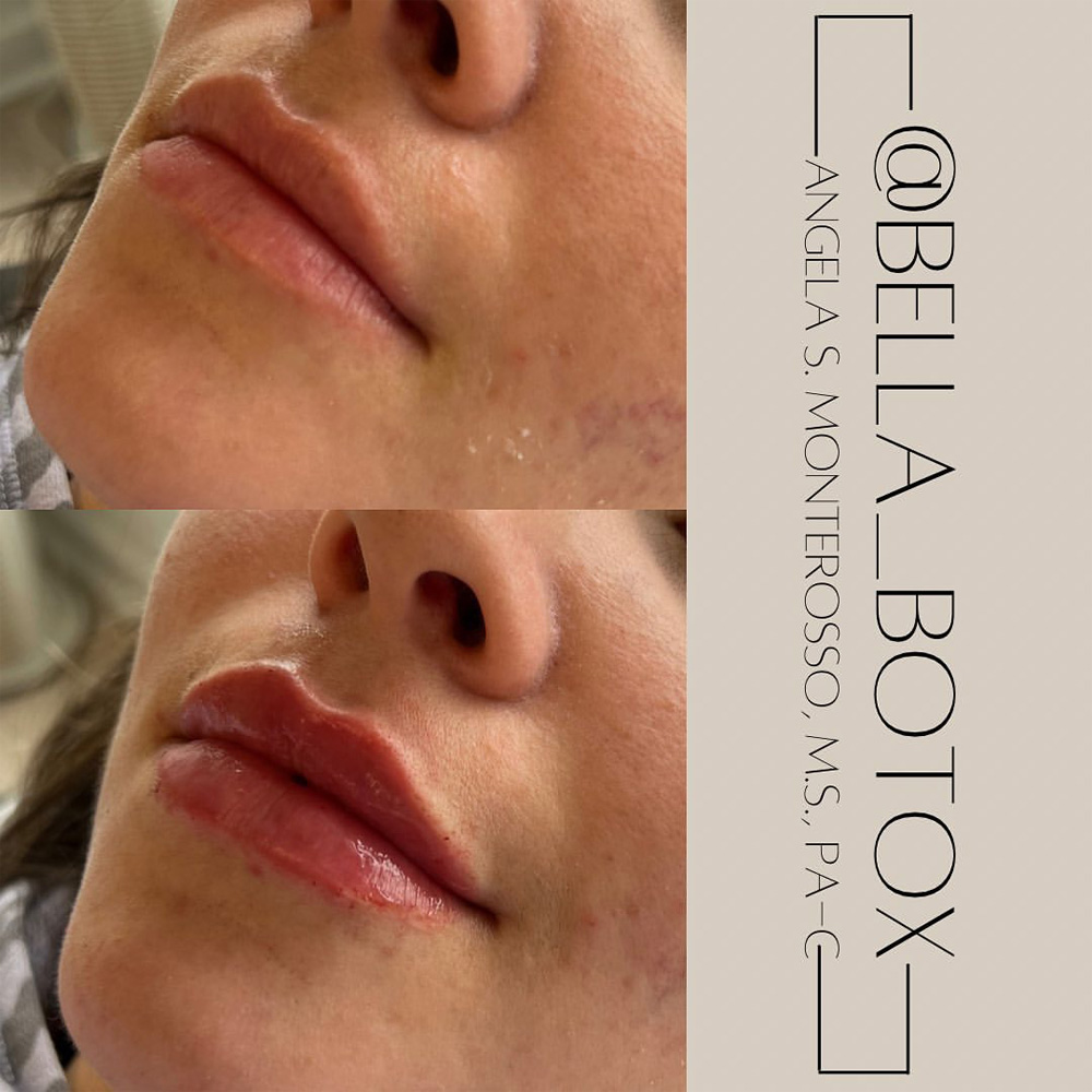 Real patient Lip Augmentation by ECA Plastic Surgery, New Jersey