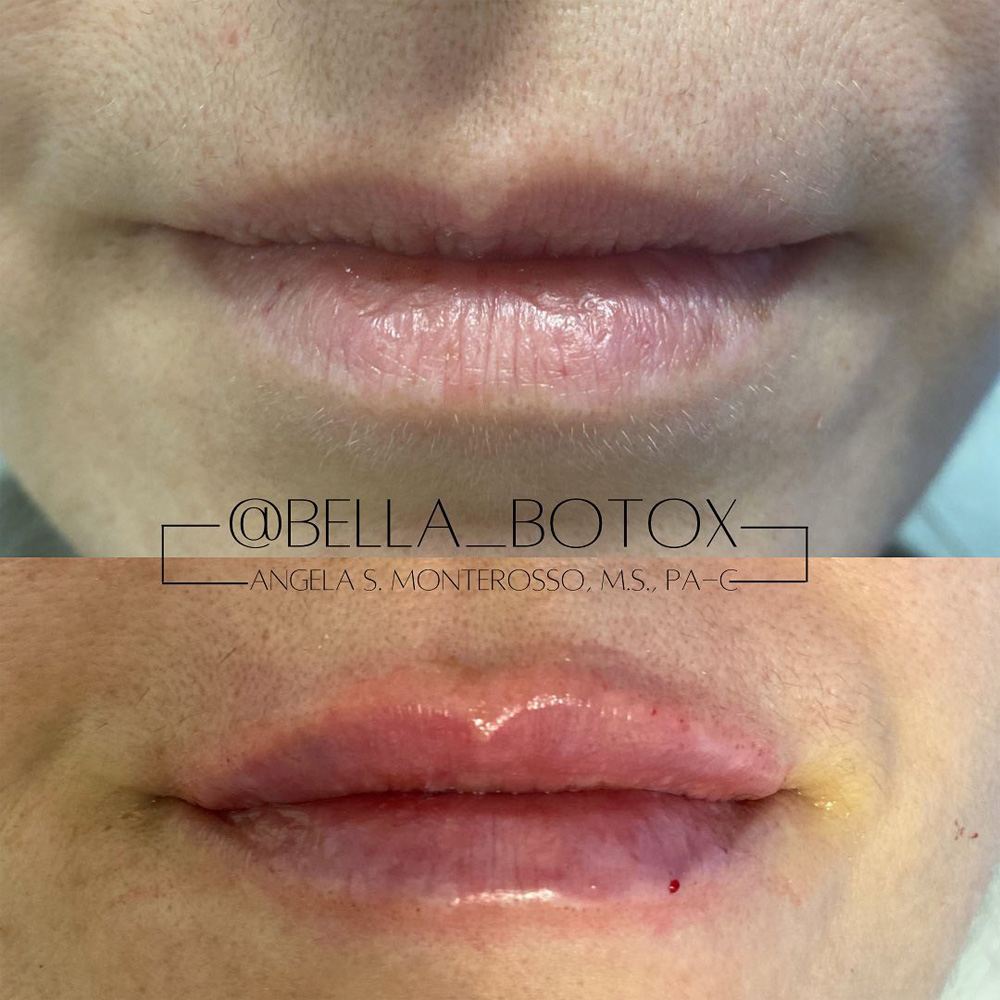 Real patient Lip Augmentation by ECA Plastic Surgery, New Jersey