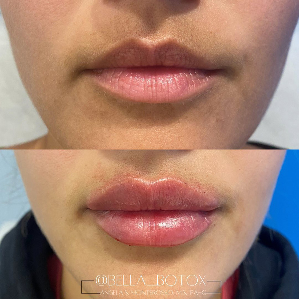 Real patient Lip Augmentation by ECA Plastic Surgery, New Jersey