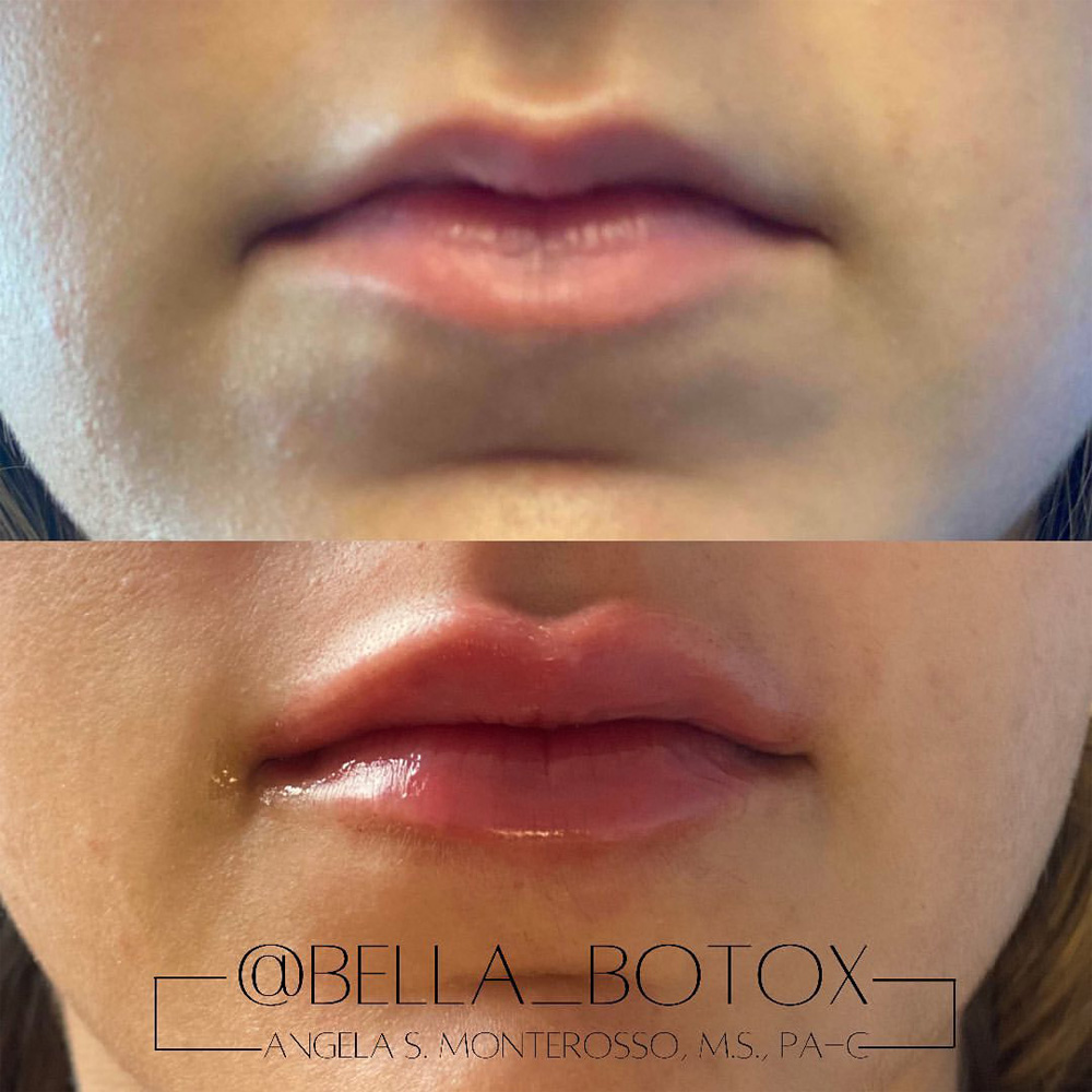 Real patient Lip Augmentation by ECA Plastic Surgery, New Jersey