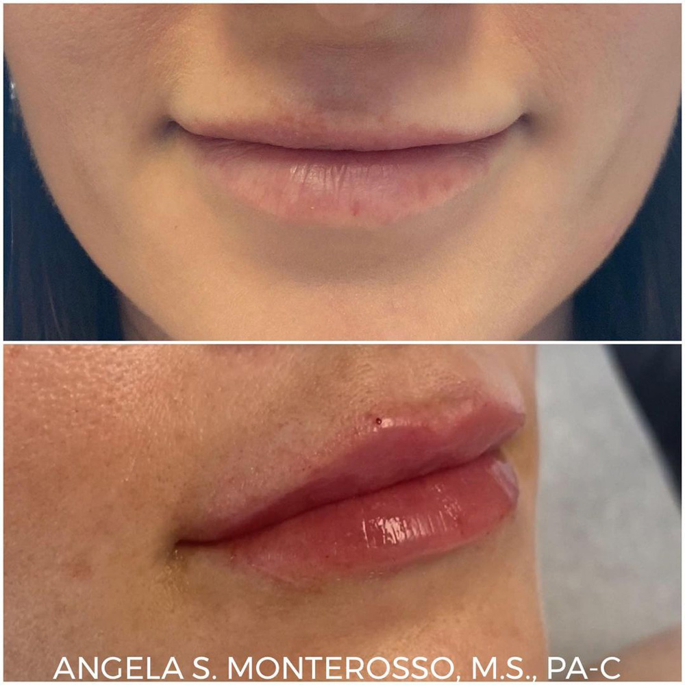 Real patient Lip Augmentation by ECA Plastic Surgery, New Jersey