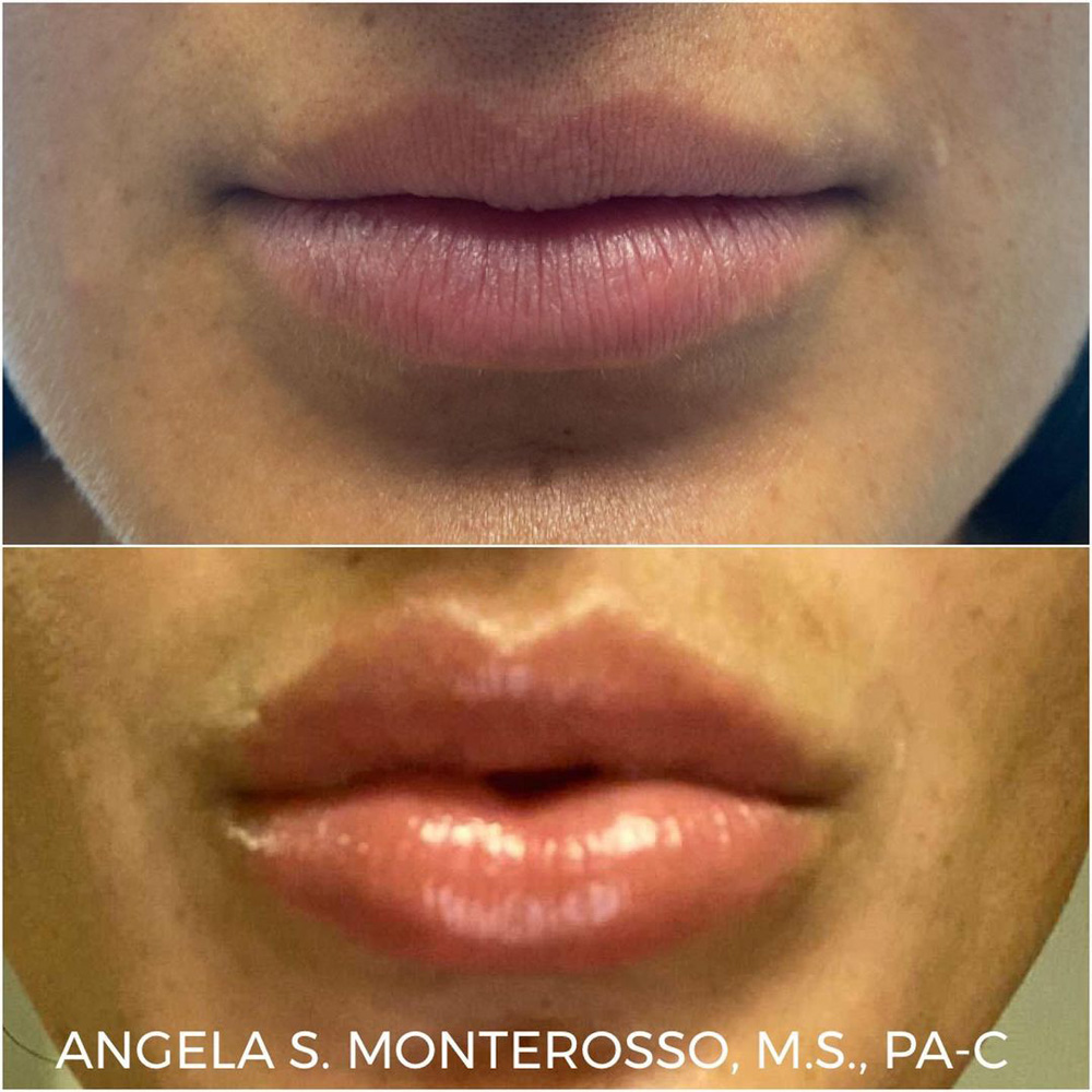 Real patient Lip Augmentation by ECA Plastic Surgery, New Jersey