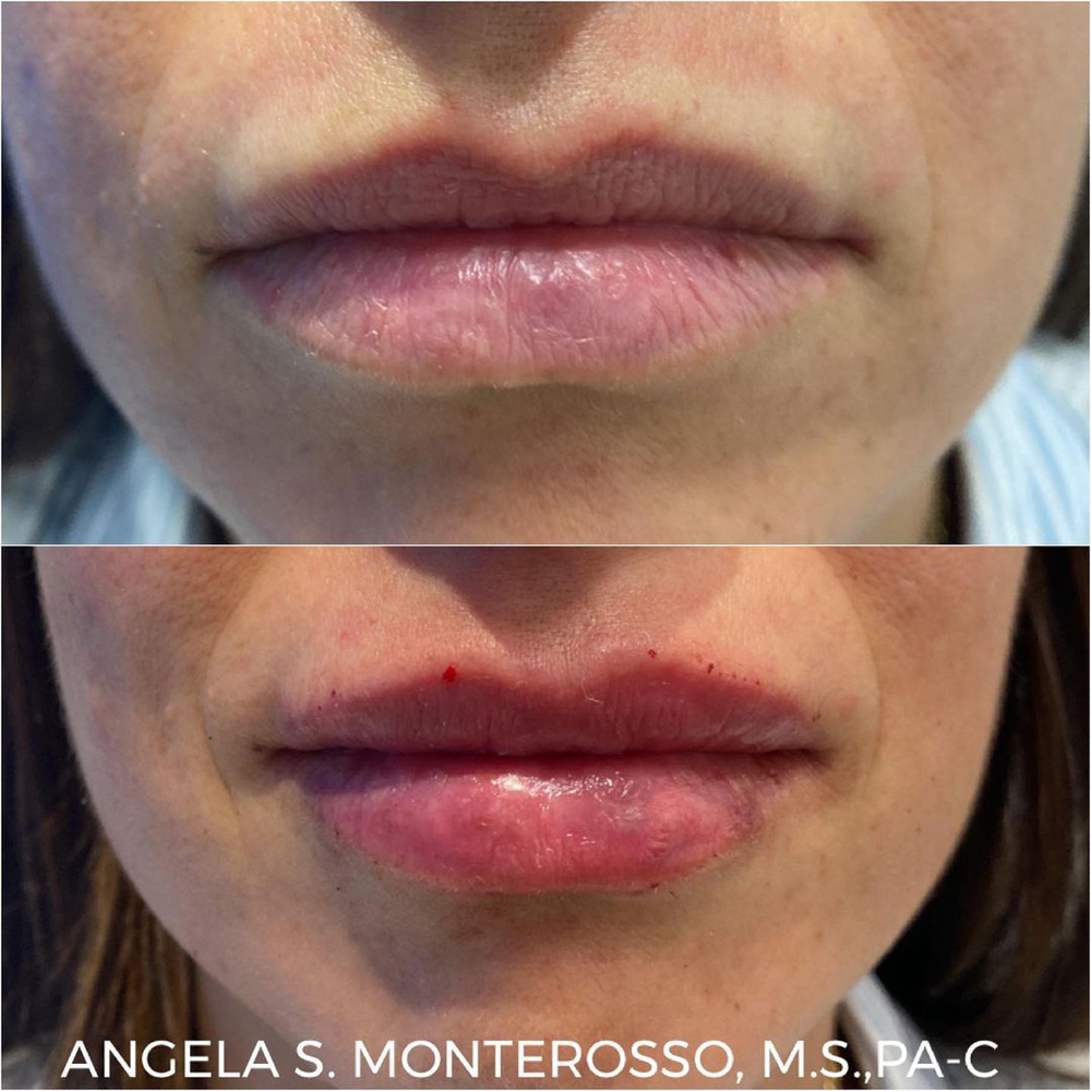 Real patient Lip Augmentation by ECA Plastic Surgery, New Jersey