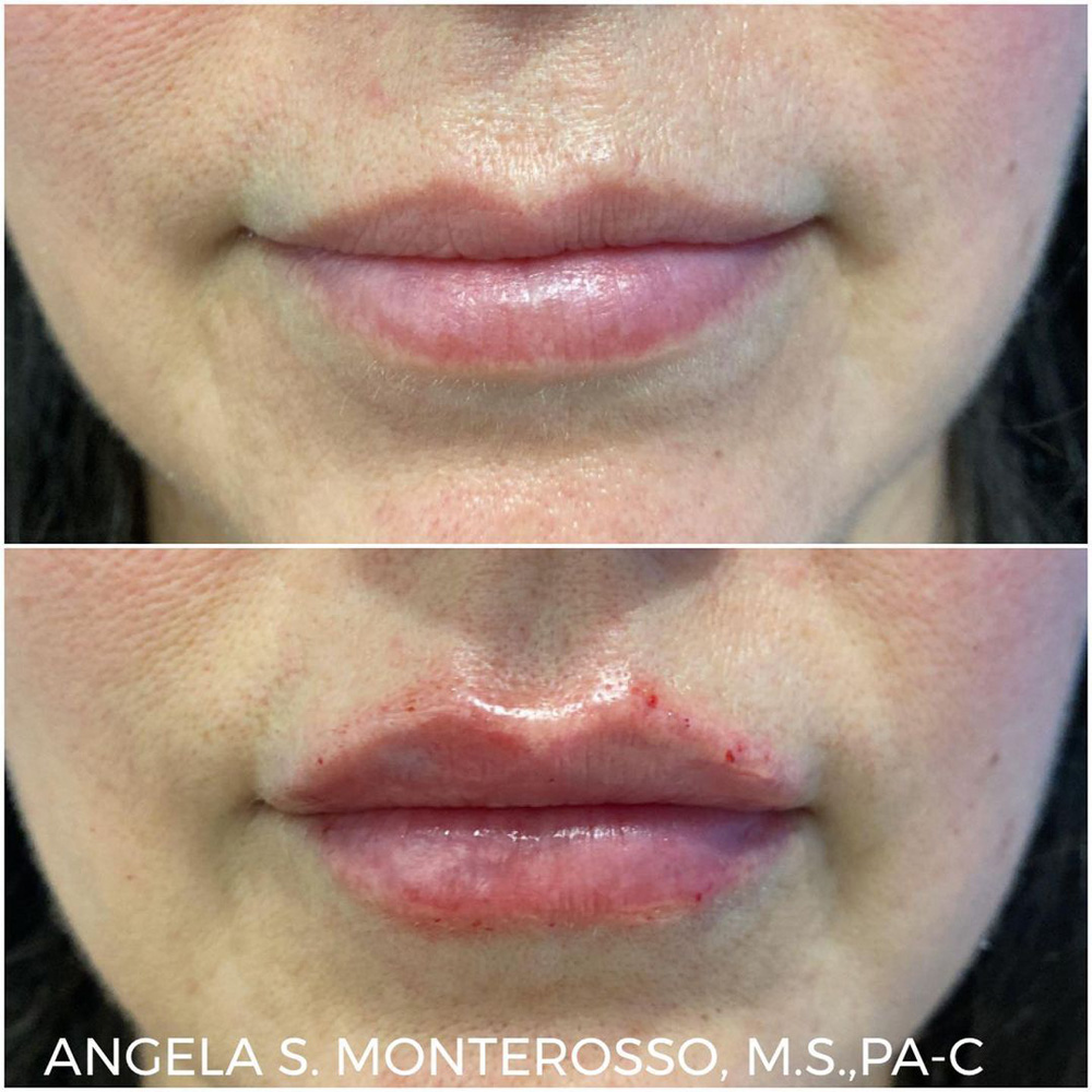 Real patient Lip Augmentation by ECA Plastic Surgery, New Jersey
