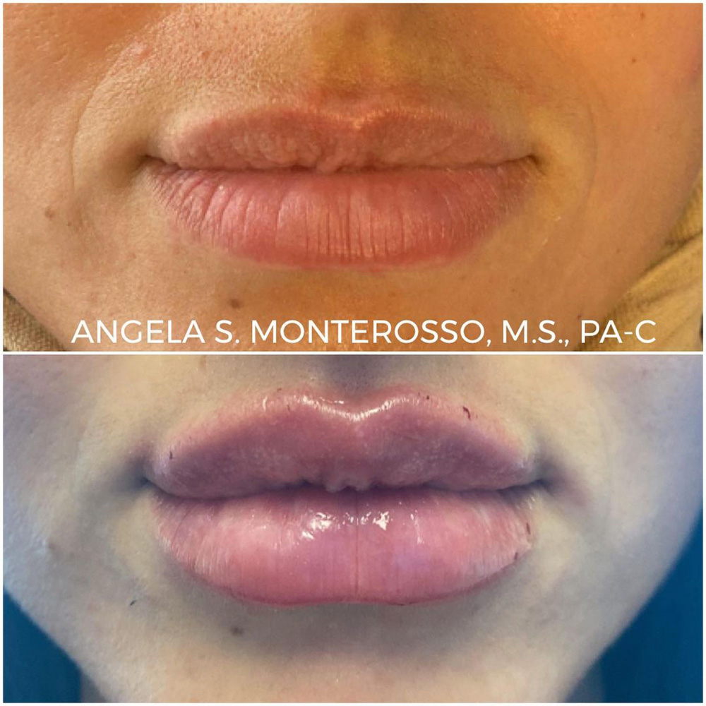 Real patient Lip Augmentation by ECA Plastic Surgery, New Jersey