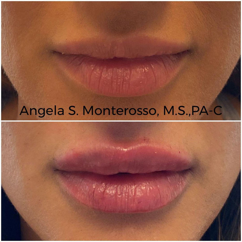 Real patient Lip Augmentation by ECA Plastic Surgery, New Jersey