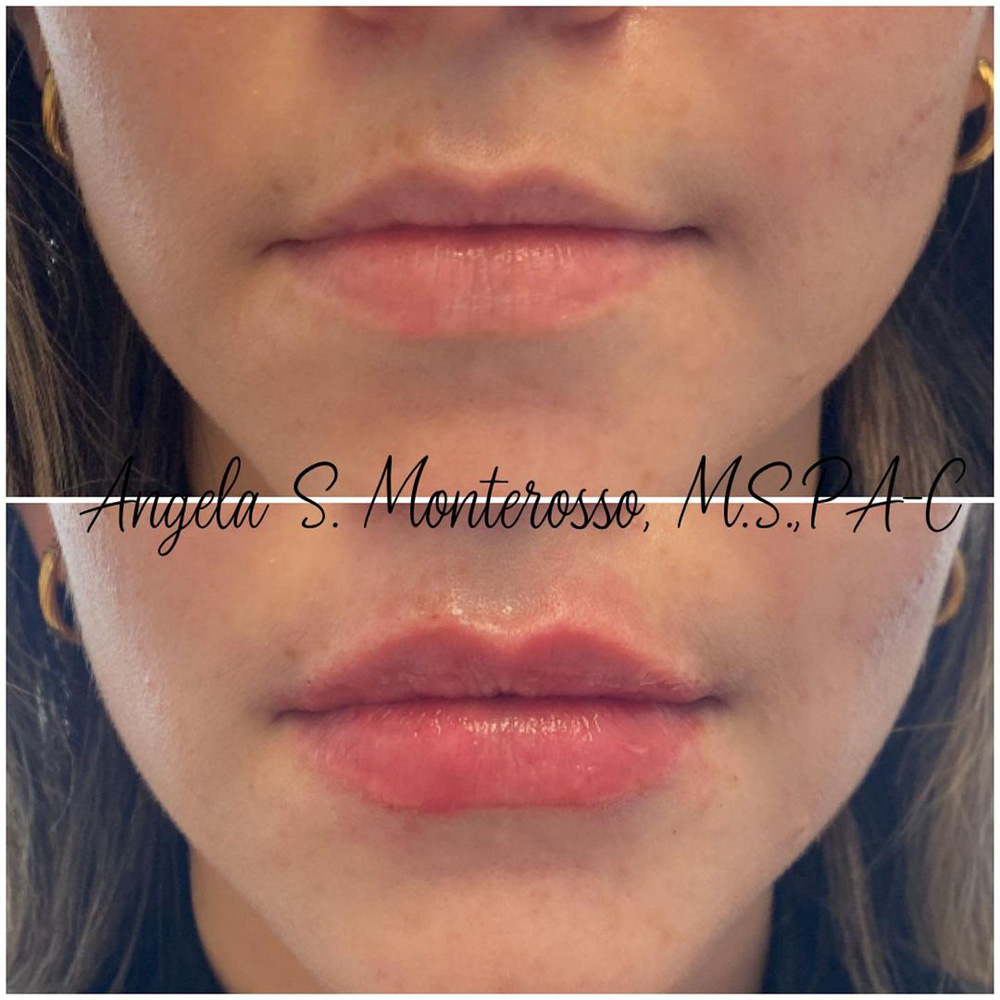 Real patient Lip Augmentation by ECA Plastic Surgery, New Jersey