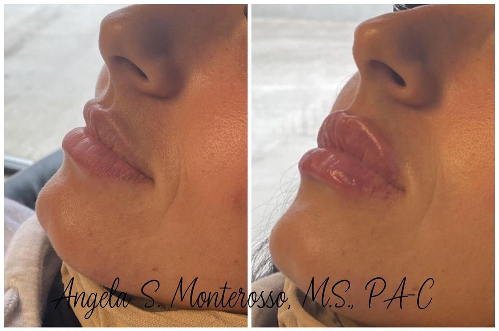 Real patient Lip Augmentation by ECA Plastic Surgery, New Jersey