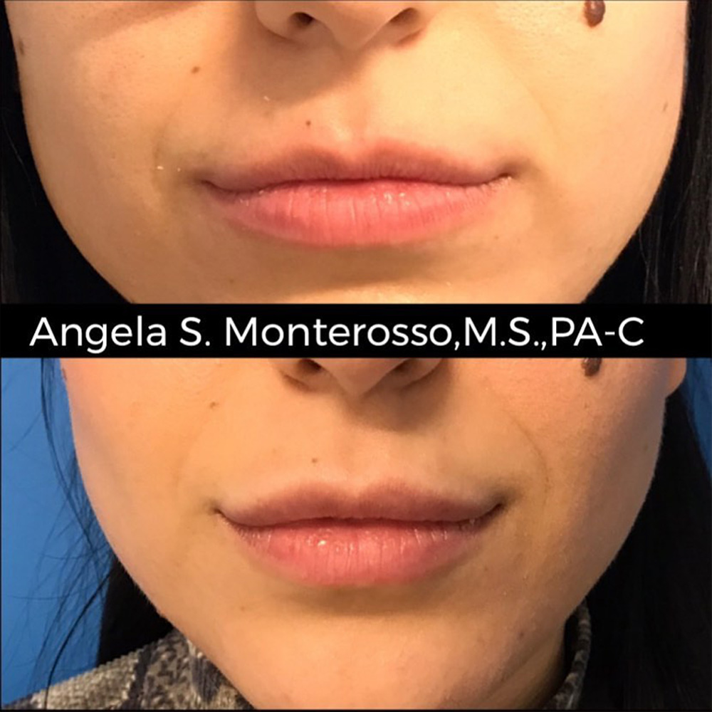 Real patient Lip Augmentation by ECA Plastic Surgery, New Jersey