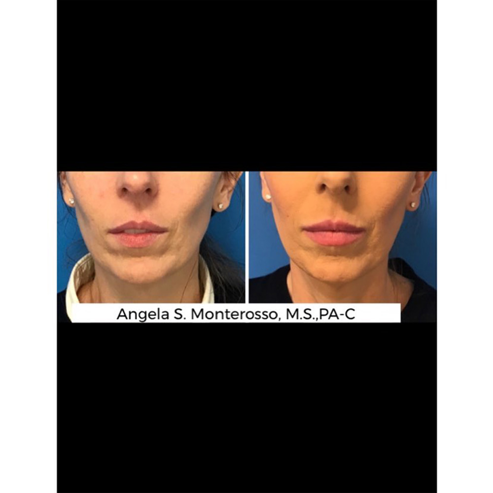 Real patient Lip Augmentation by ECA Plastic Surgery, New Jersey