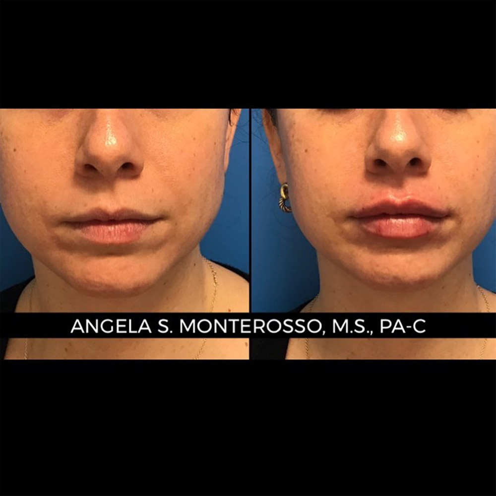 Real patient Lip Augmentation by ECA Plastic Surgery, New Jersey