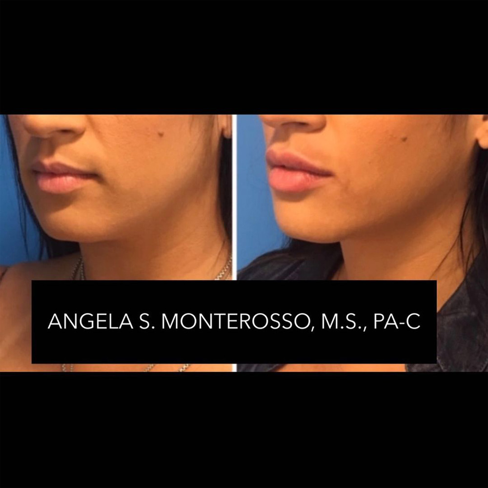 Real patient Lip Augmentation by ECA Plastic Surgery, New Jersey