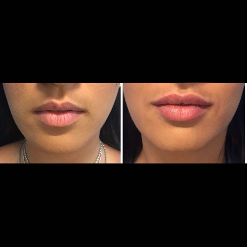Real patient Lip Augmentation by ECA Plastic Surgery, New Jersey