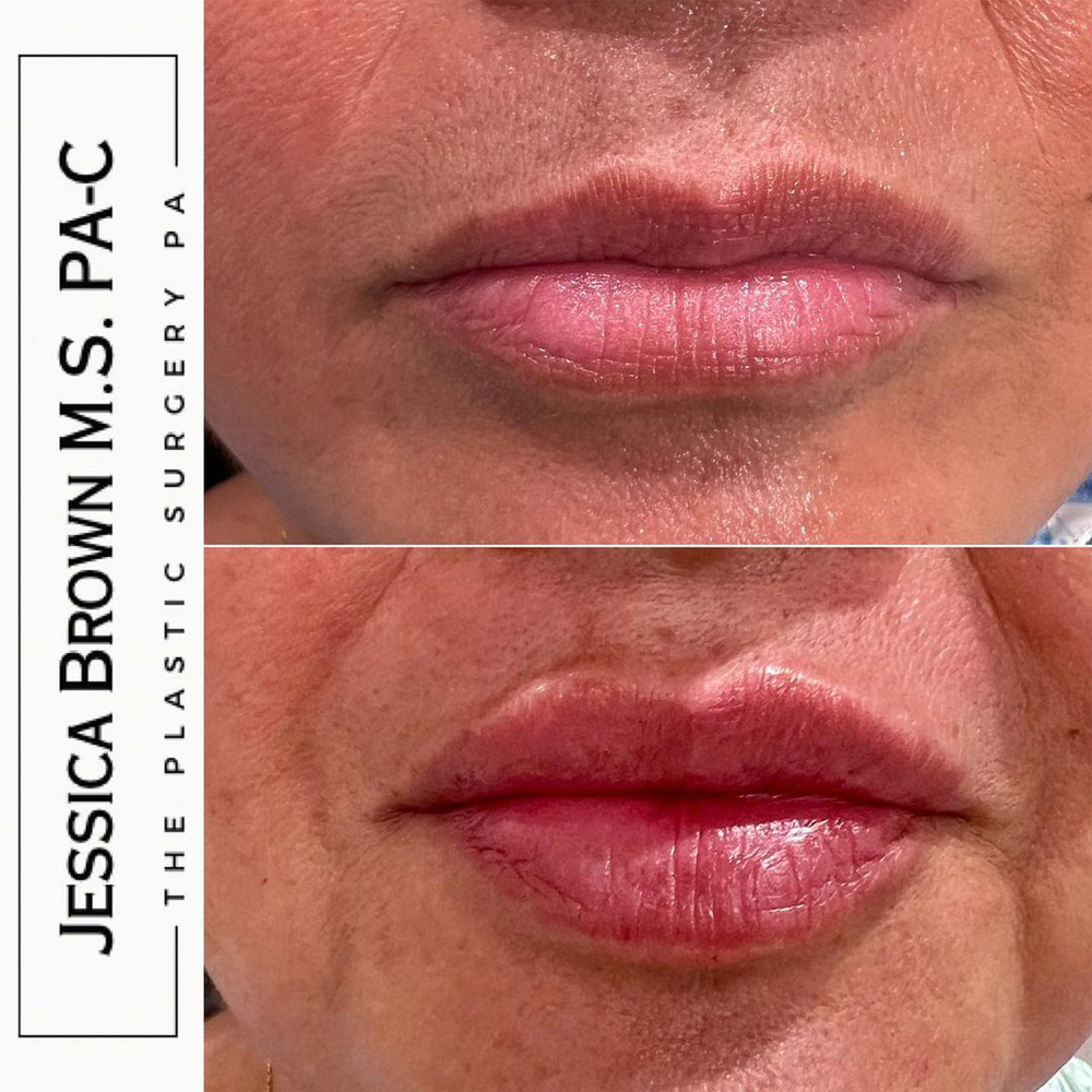 Real patient Lip Augmentation by ECA Plastic Surgery, New Jersey
