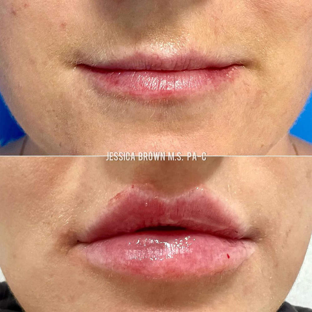 Real patient Lip Augmentation by ECA Plastic Surgery, New Jersey