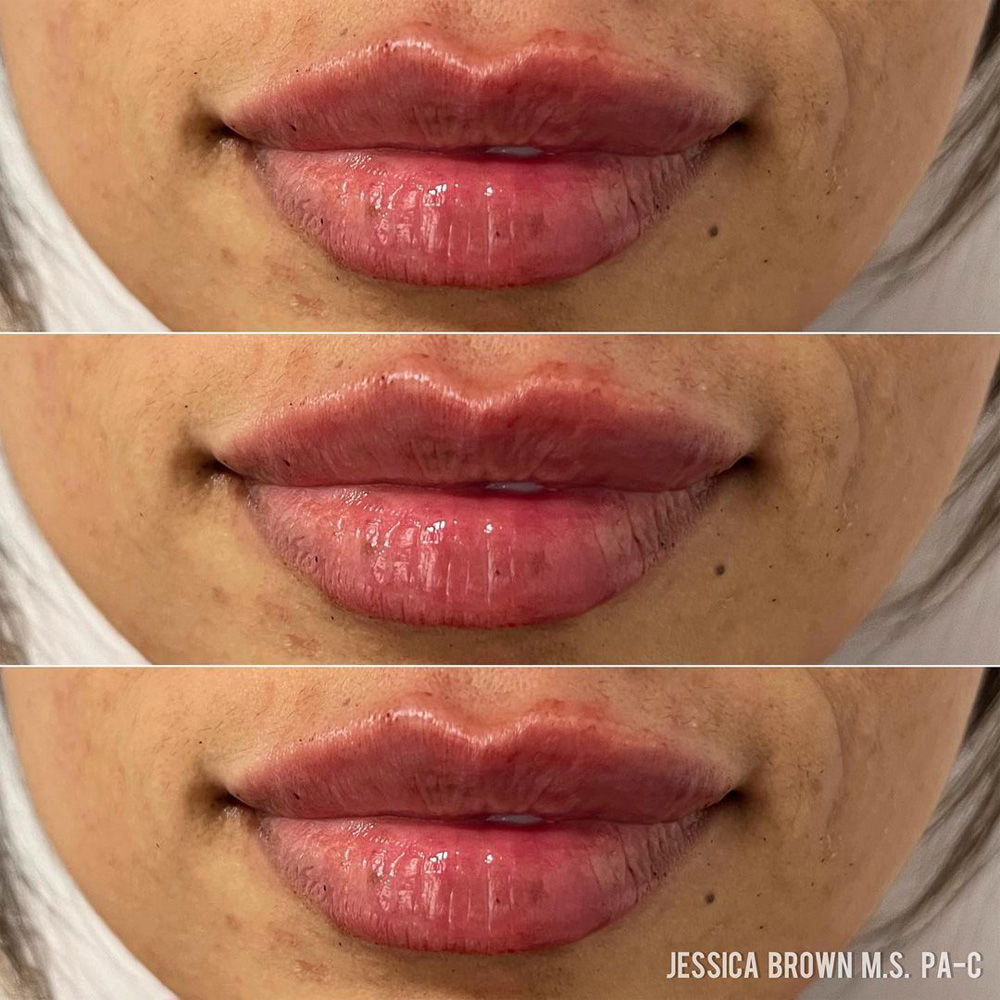 Real patient Lip Augmentation by ECA Plastic Surgery, New Jersey