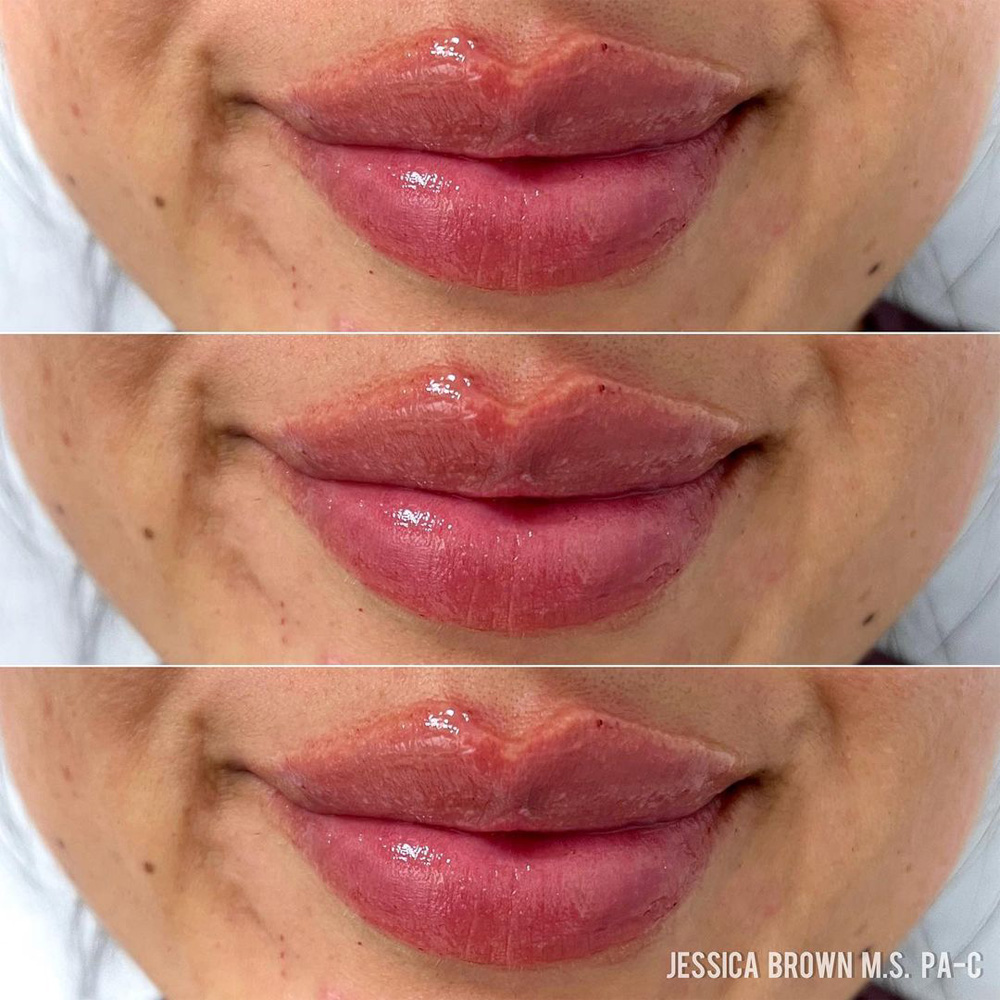 Real patient Lip Augmentation by ECA Plastic Surgery, New Jersey