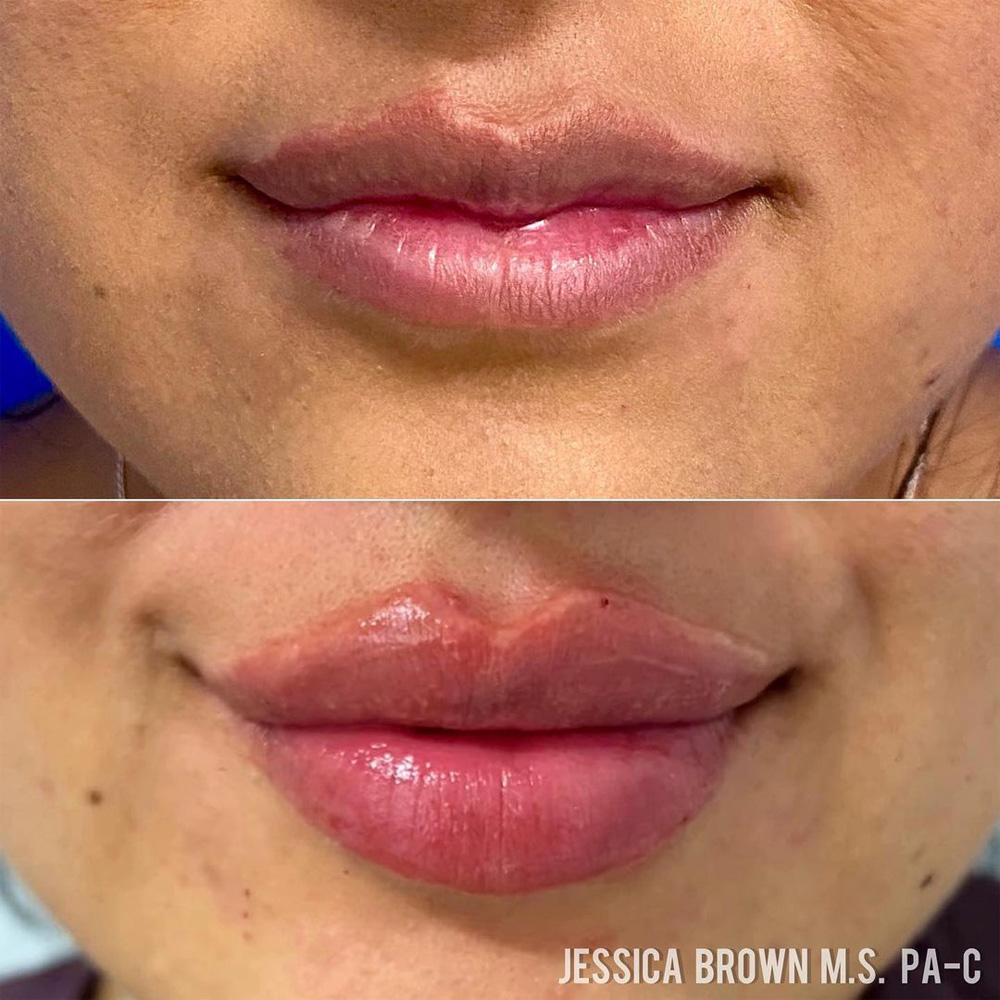 Real patient Lip Augmentation by ECA Plastic Surgery, New Jersey
