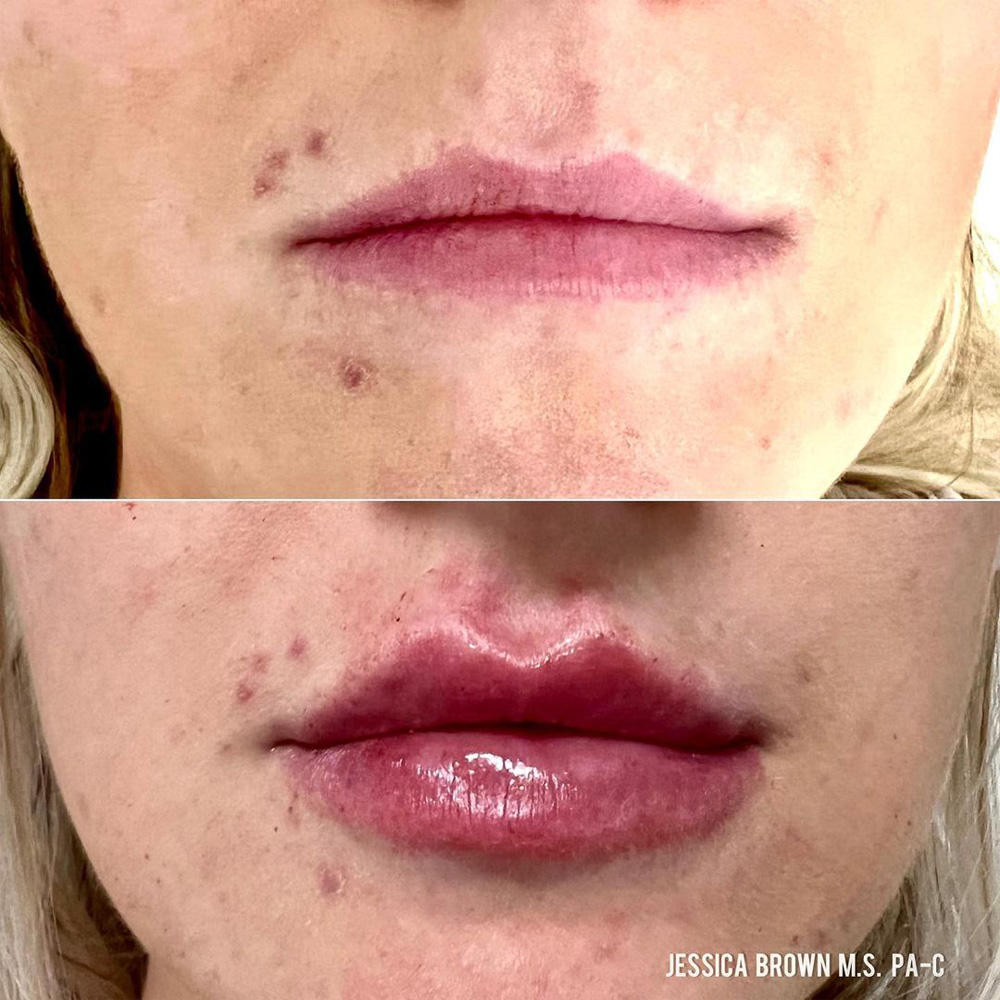 Real patient Lip Augmentation by ECA Plastic Surgery, New Jersey