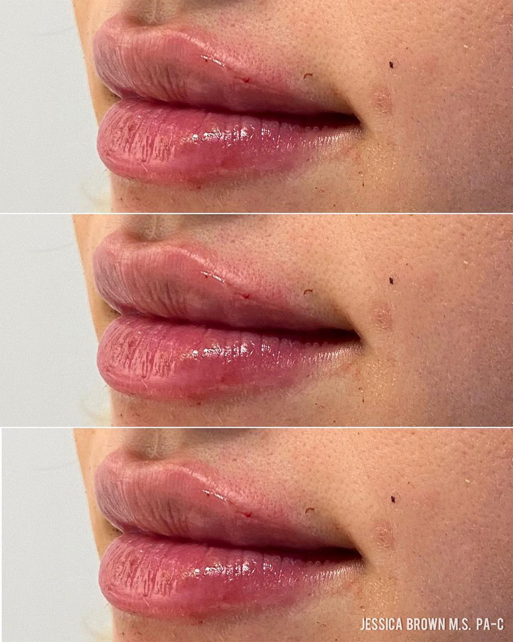 Real patient Lip Augmentation by ECA Plastic Surgery, New Jersey