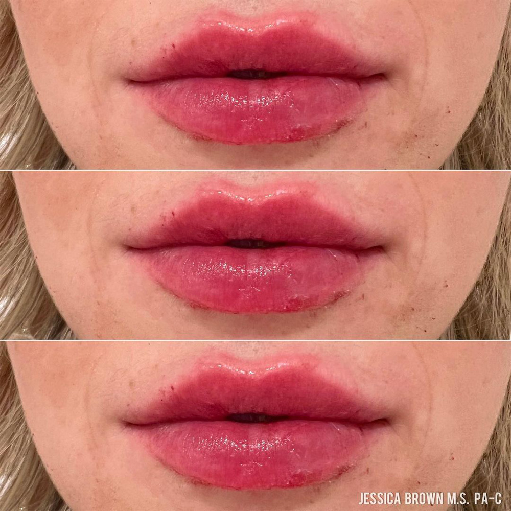 Real patient Lip Augmentation by ECA Plastic Surgery, New Jersey