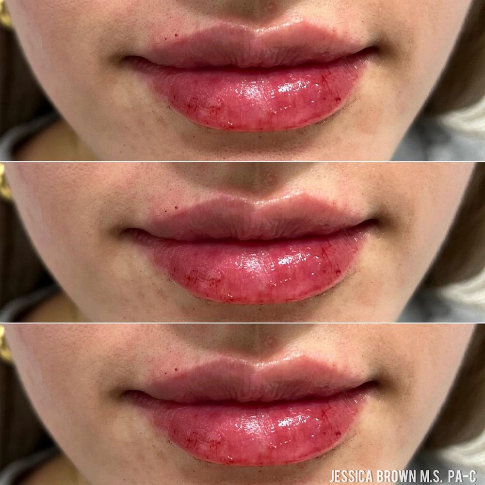 Real patient Lip Augmentation by ECA Plastic Surgery, New Jersey