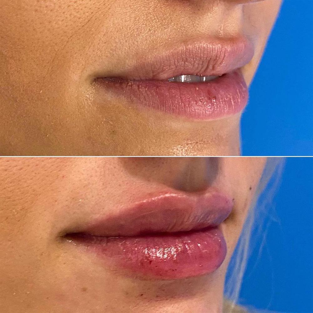 Real patient Lip Augmentation by ECA Plastic Surgery, New Jersey